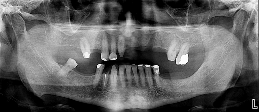 caso 331 idm radiografia panoramica