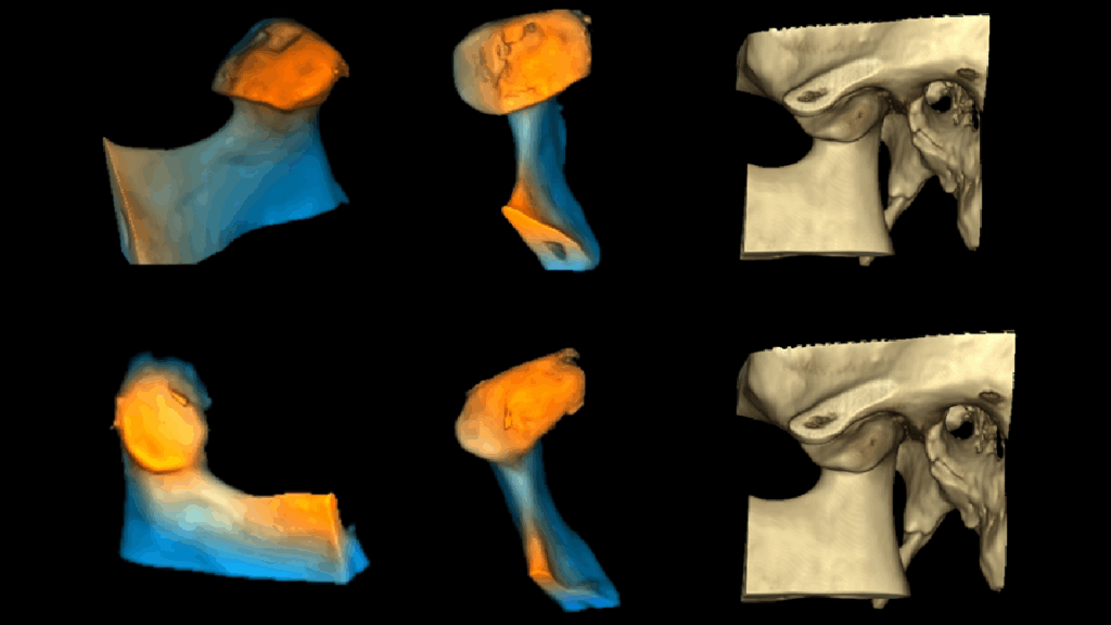 caso 332 idm RECONSTRUCCION 3D
