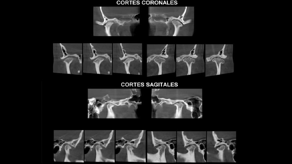 caso 332 idm cortes CORONALES Y SAGITALES 02