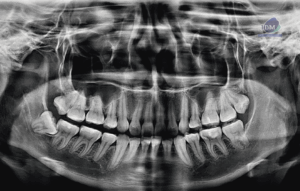 caso 332 idm radiografia panoramica 01