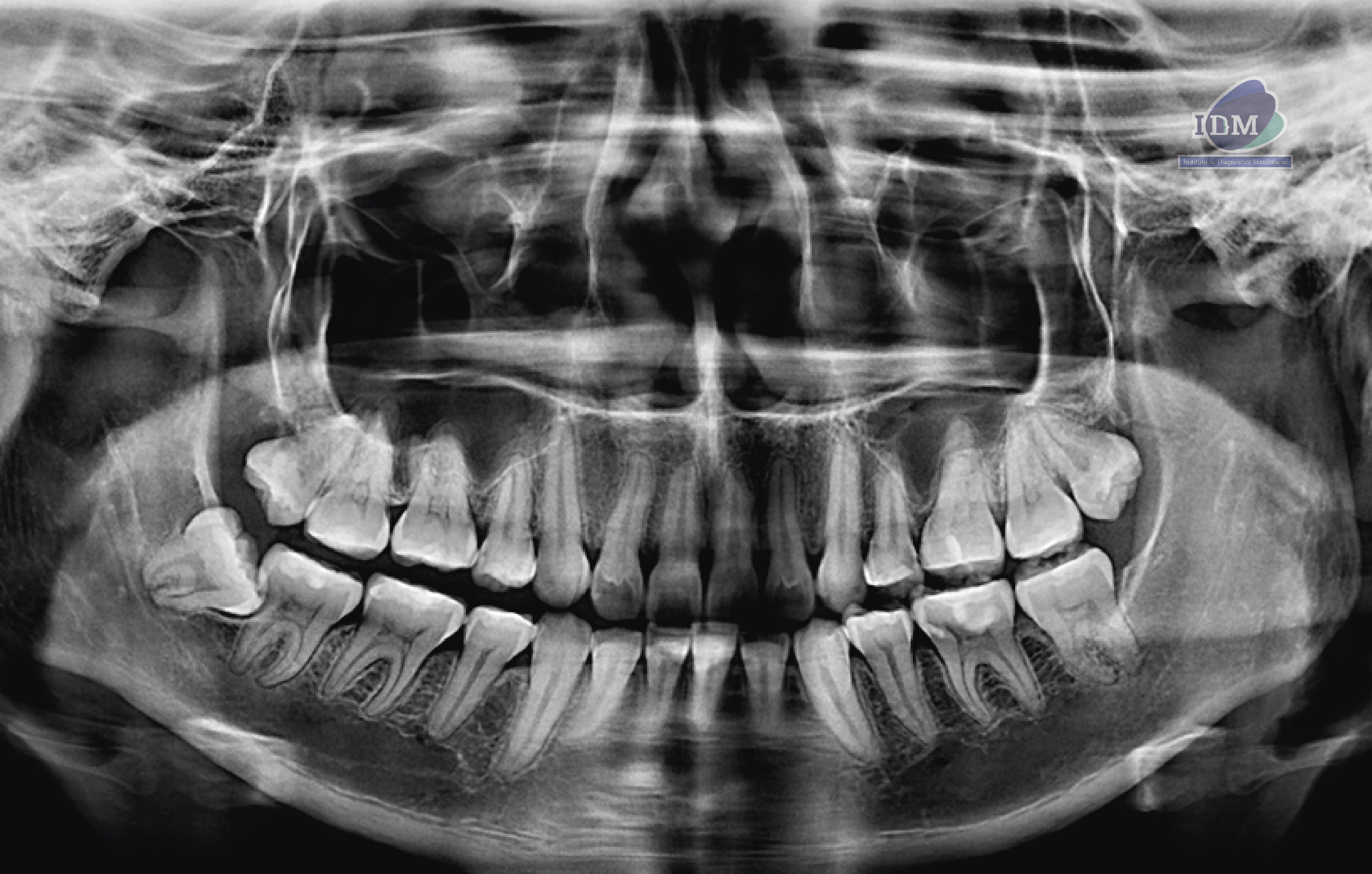 caso 332 idm radiografia panoramica 01