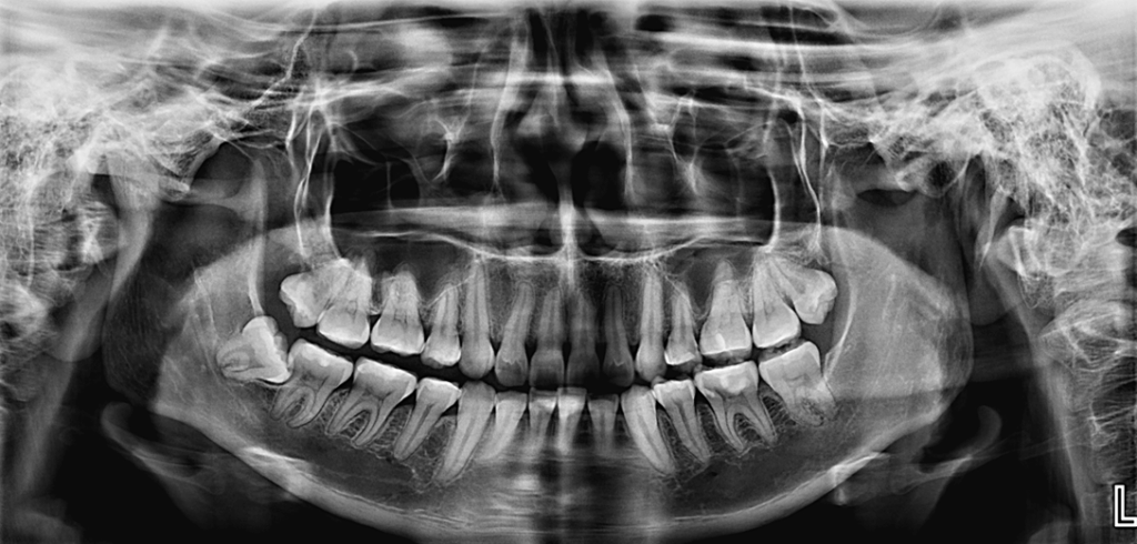 caso 332 idm radiografia panoramica