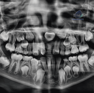 CASO 333 - RADIOGRAFIA PANORAMICA - IDM V2