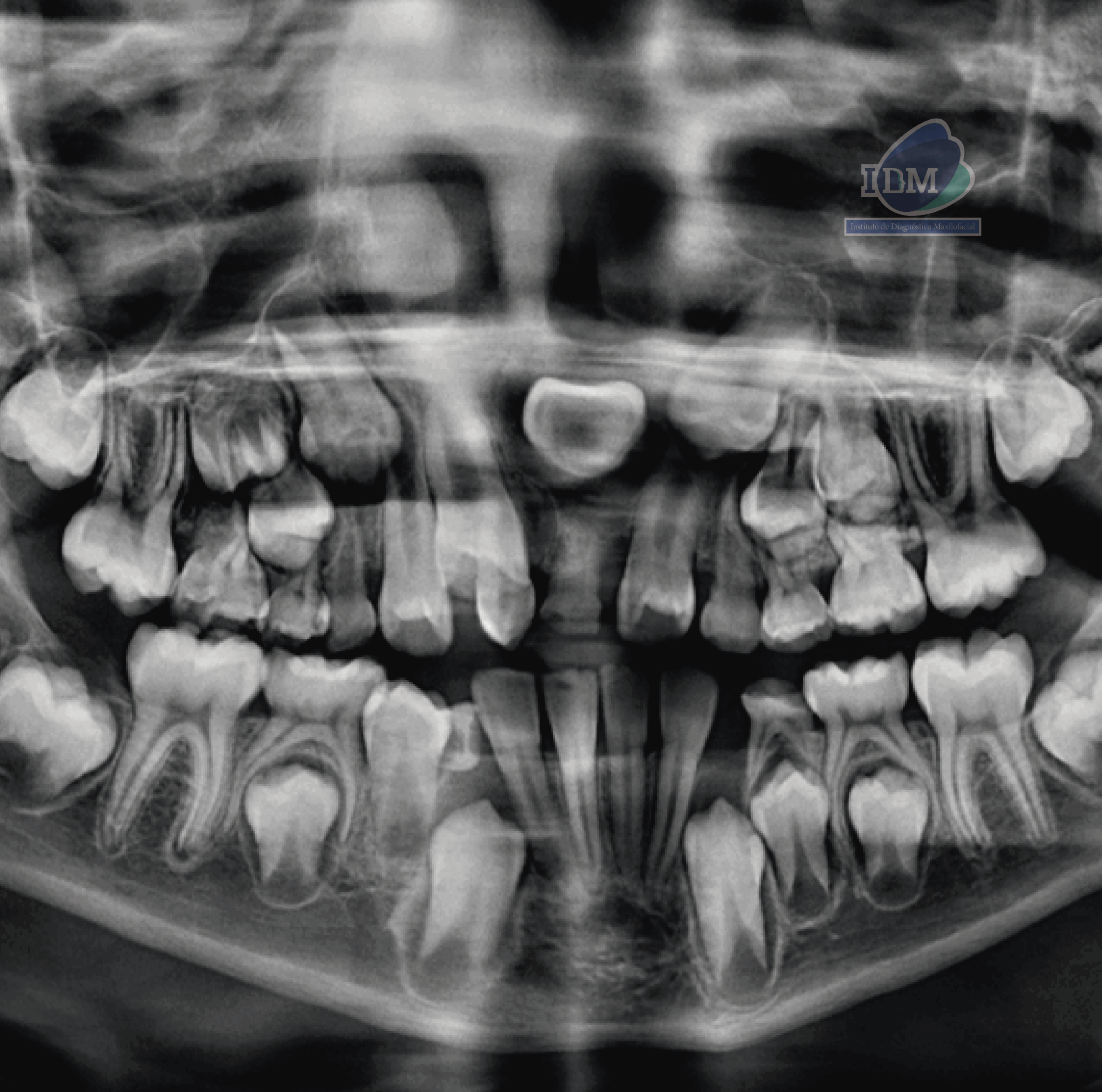 CASO 333 - RADIOGRAFIA PANORAMICA - IDM V2