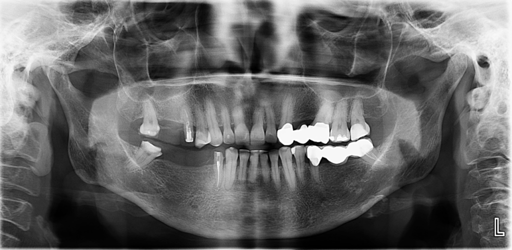CASO 334 - RADIOGRAFIA PANORAMICA - IDM