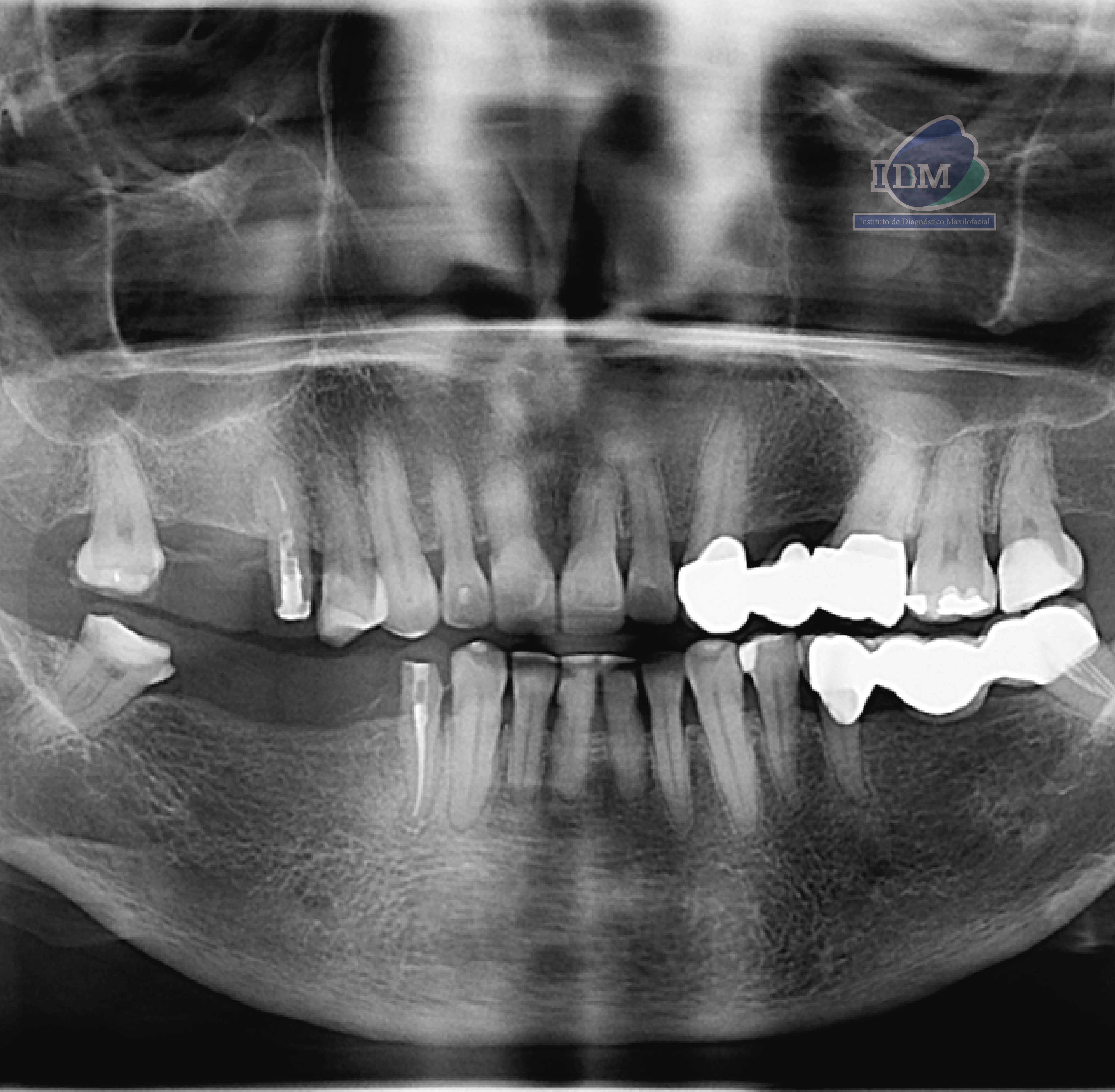 CASO 334 - RADIOGRAFIA PANORAMICA - IDM - V2
