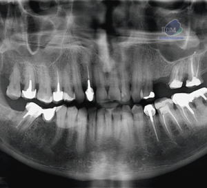 CASO 335 - RADIOGRAFIA PANORAMICA - IDM - V2