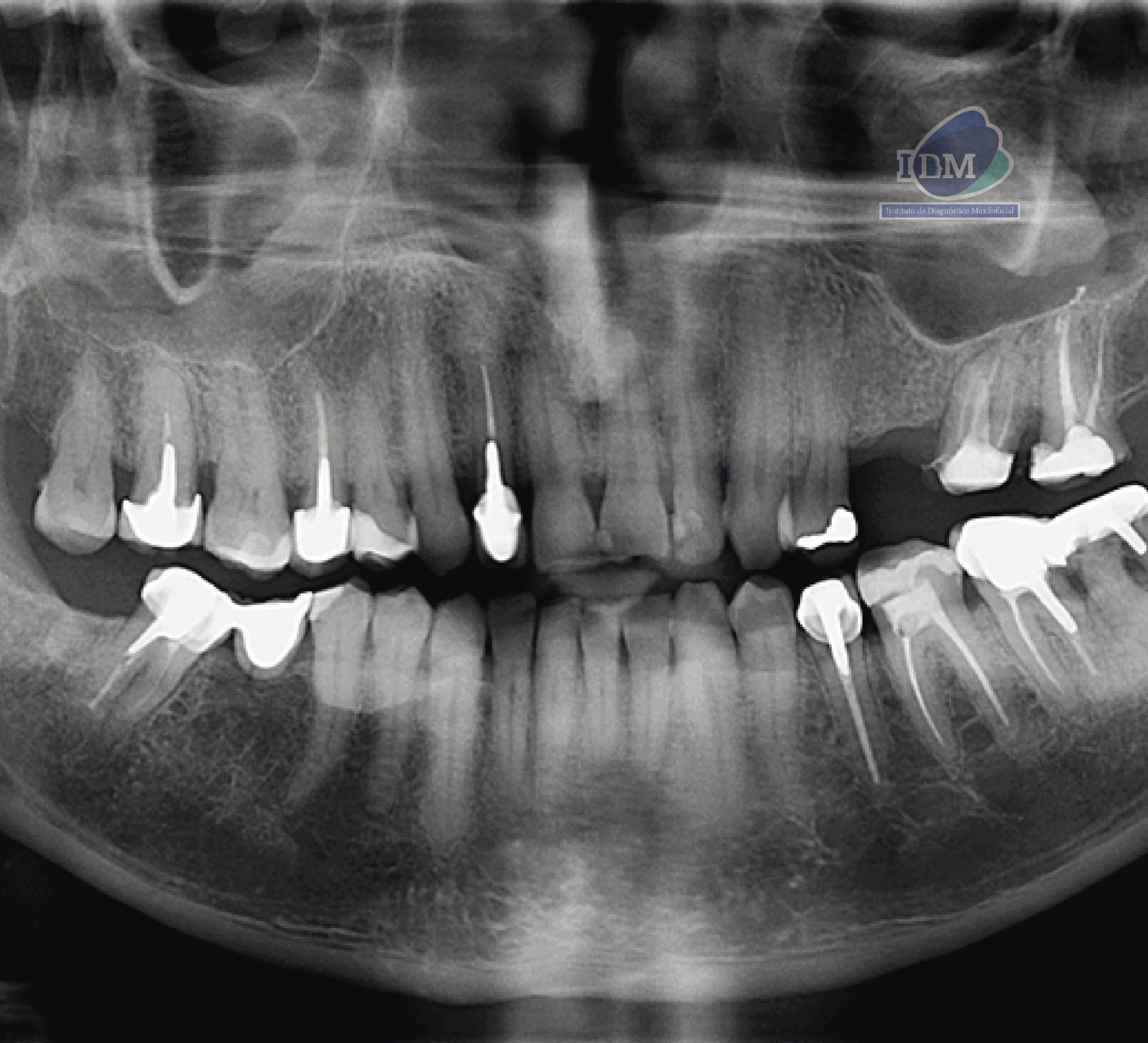 CASO 335 - RADIOGRAFIA PANORAMICA - IDM - V2