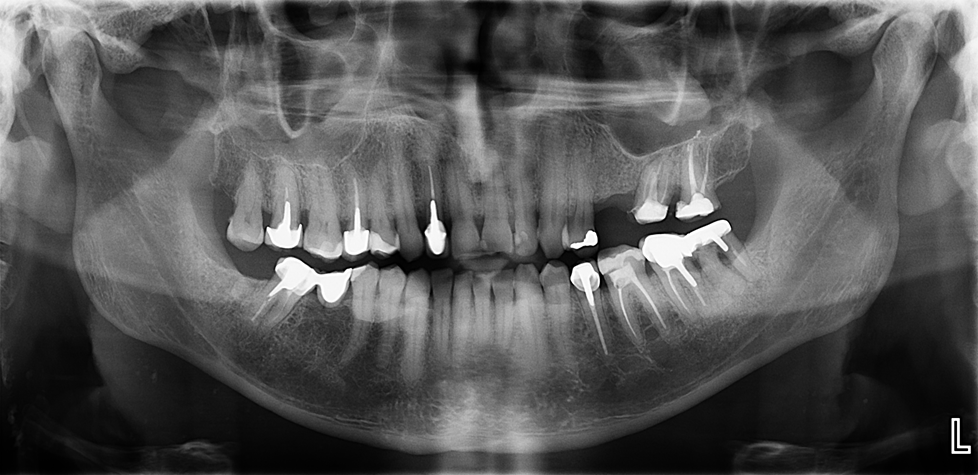 CASO 335 - RADIOGRAFIA PANORAMICA - IDM
