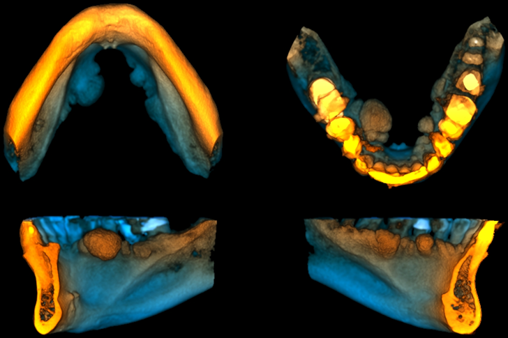 CASO 335 - RECONSTRUCCION 3D - IDM