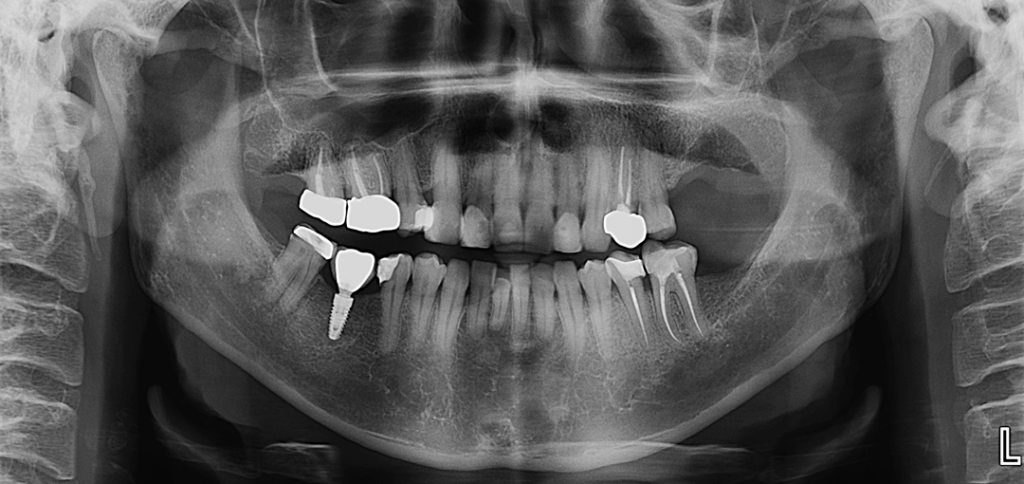 CASO 336 - RADIOGRAFIA PANORAMICA - IDM