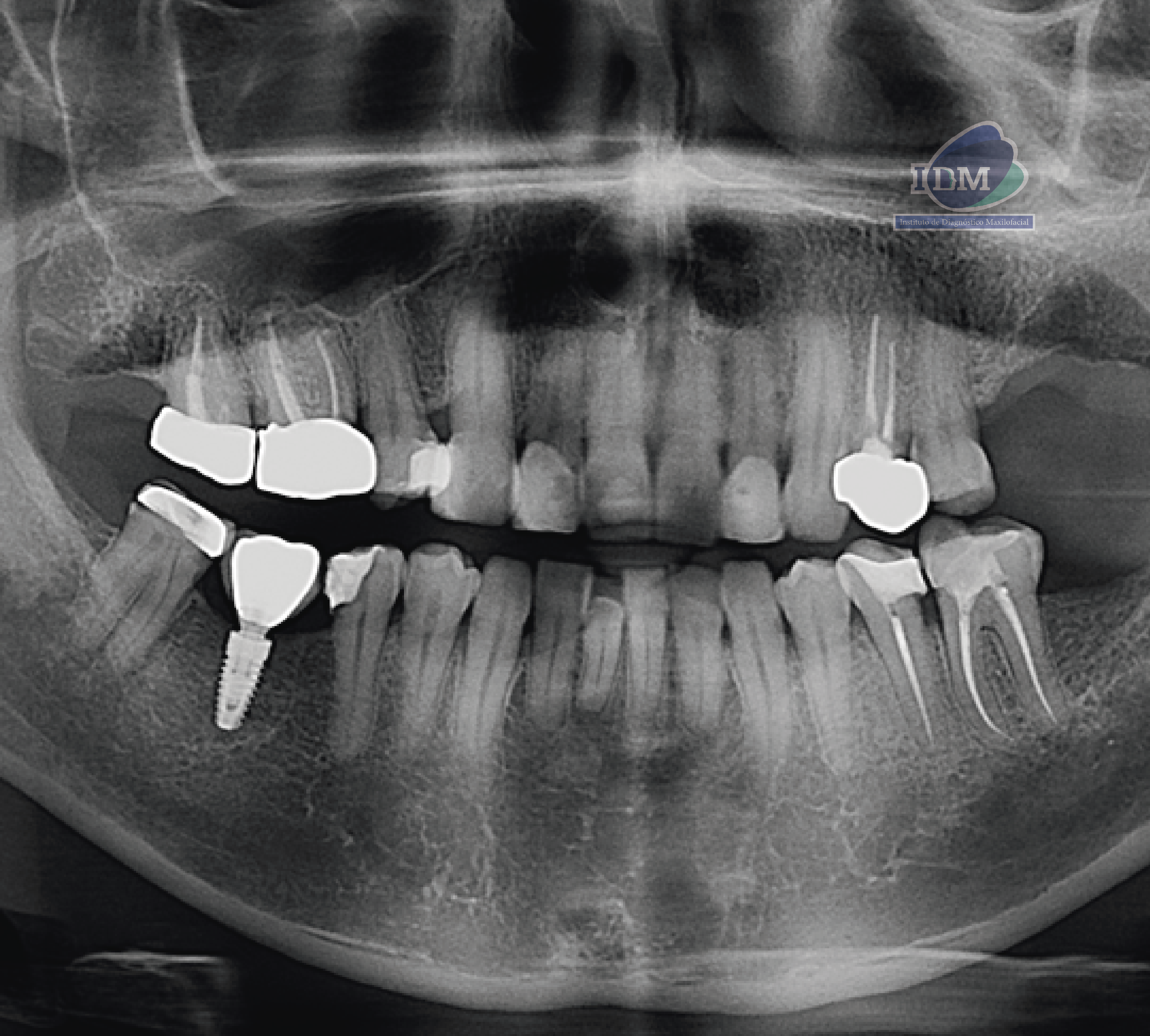 CASO 336 - RADIOGRAFIA PANORAMICA - IDM - V2