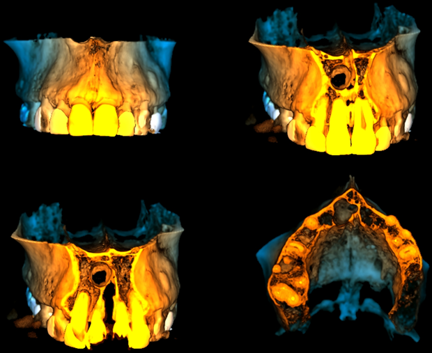CASO 336 - RECONSTRUCCION 3D - IDM
