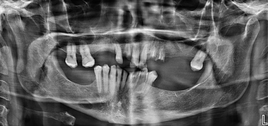 CASO 337 - RADIOGRAFIA PANORAMICA - IDM