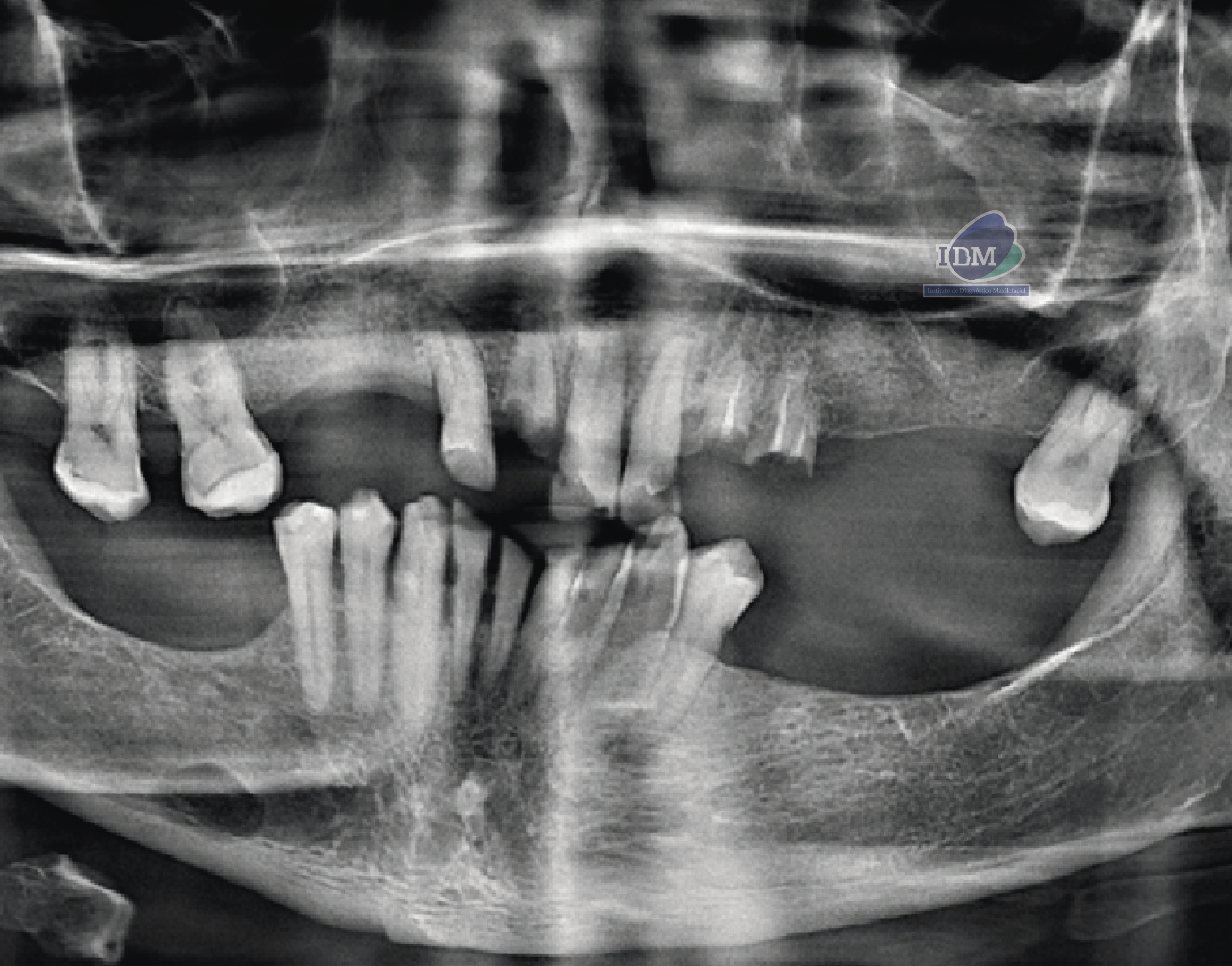 CASO 337 - RADIOGRAFIA PANORAMICA - IDM - V2