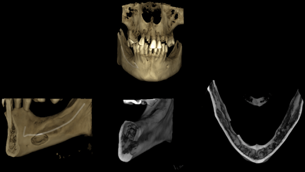 CASO 337 - RECONSTRUCCION 3D - IDM
