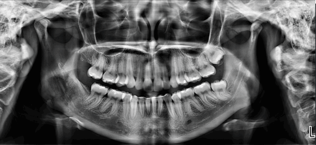 caso 338 - radiografia panoramica 02 IDM_Rad Pan 02