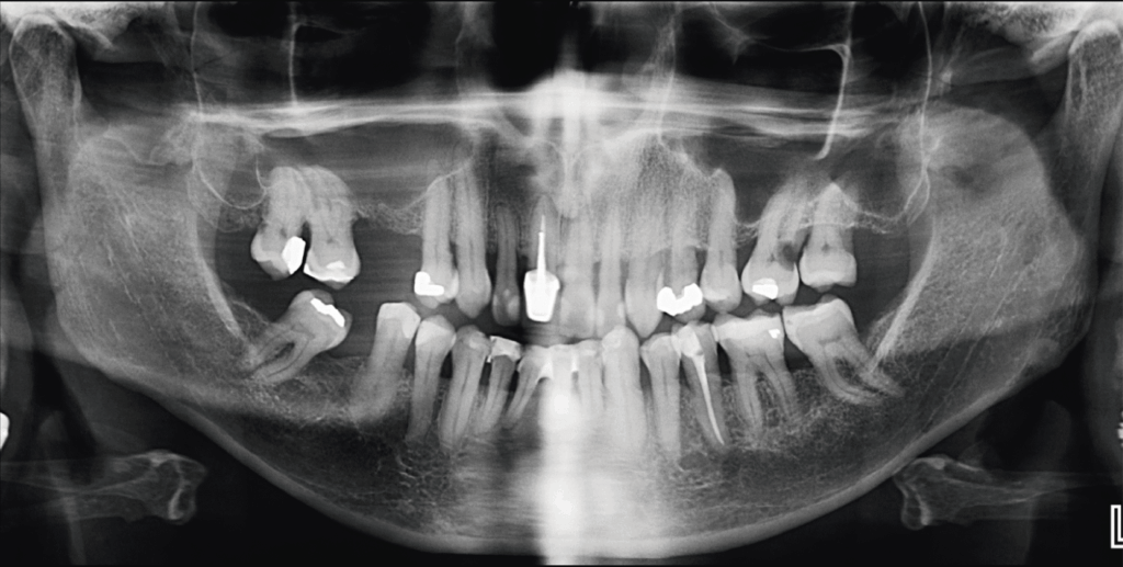 caso 338 - radiografia panoramica 02 IDM_Rad Pan 02