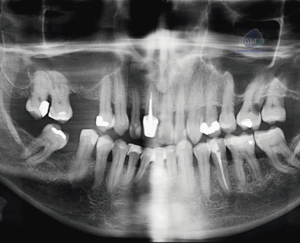 caso 338 - radiografia panoramica IDM