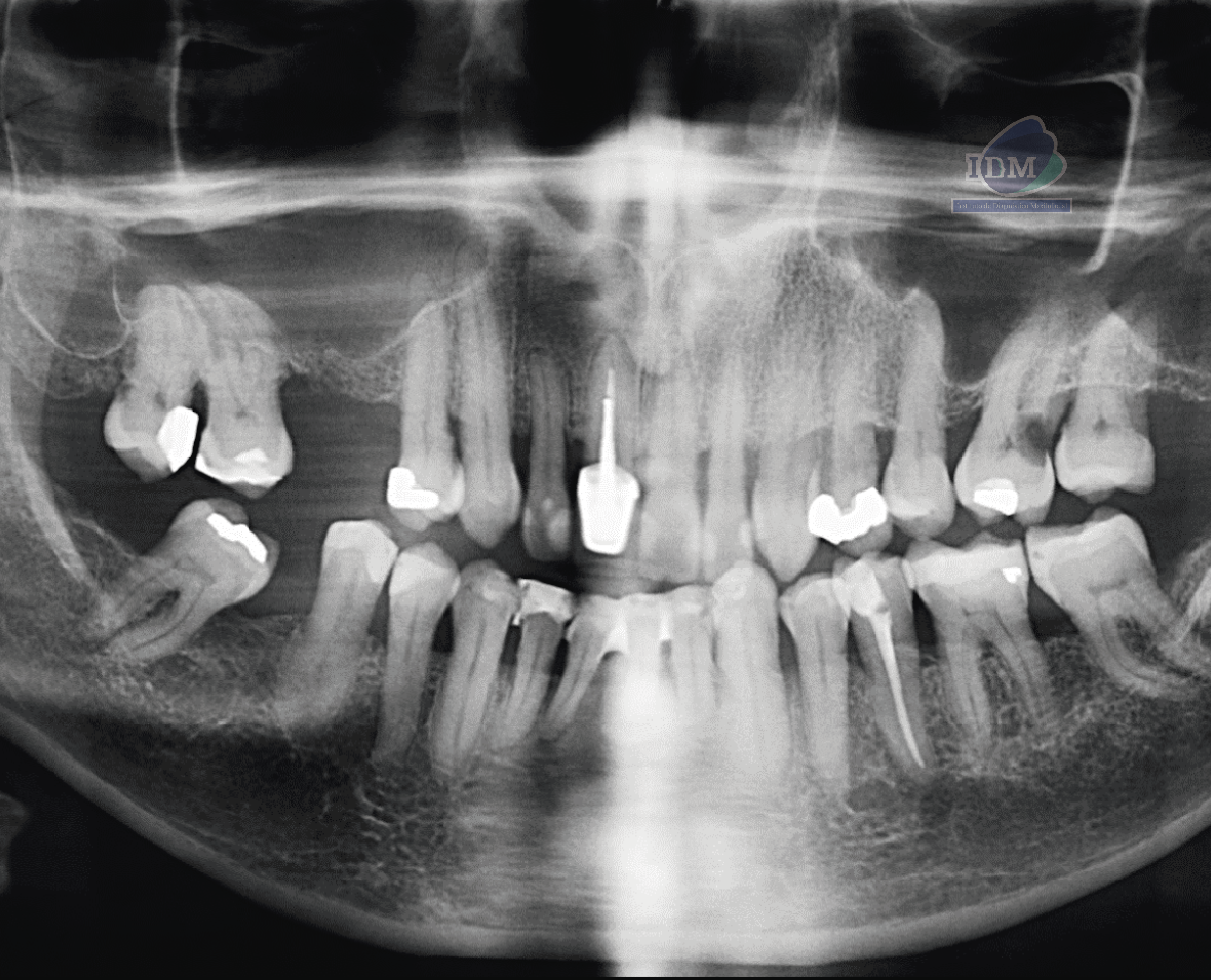 caso 338 - radiografia panoramica IDM