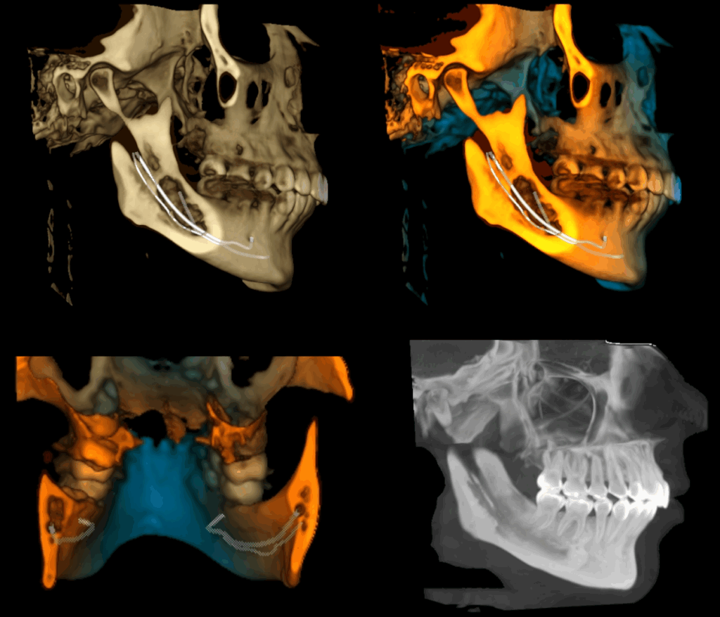caso 339 - RECONSTRUCCION 3D IDM_rec 3d