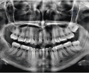 caso 339 - radiografia panoramica IDM_Rad Pan 01