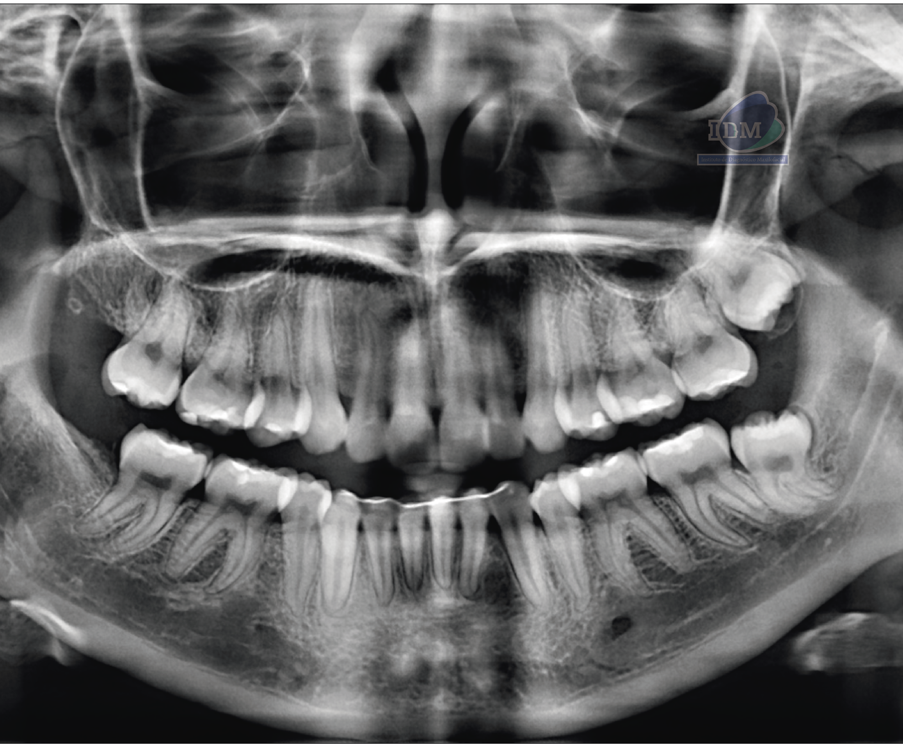 caso 339 - radiografia panoramica IDM_Rad Pan 01