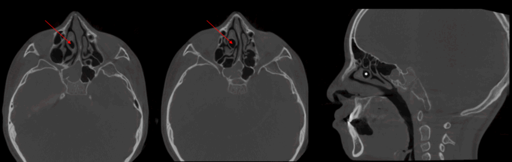 caso 340 - CORTES AXIALES Y SAGITALES IDM
