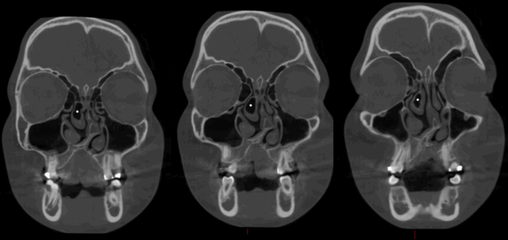 caso 340 - CORTES CORONALES IDM