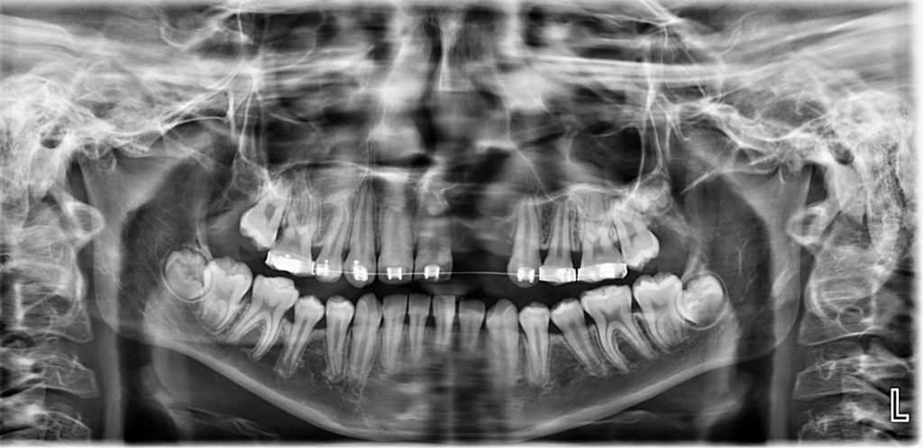 caso 340 - radiografia panoramica 02 IDM_Rad Pan 02