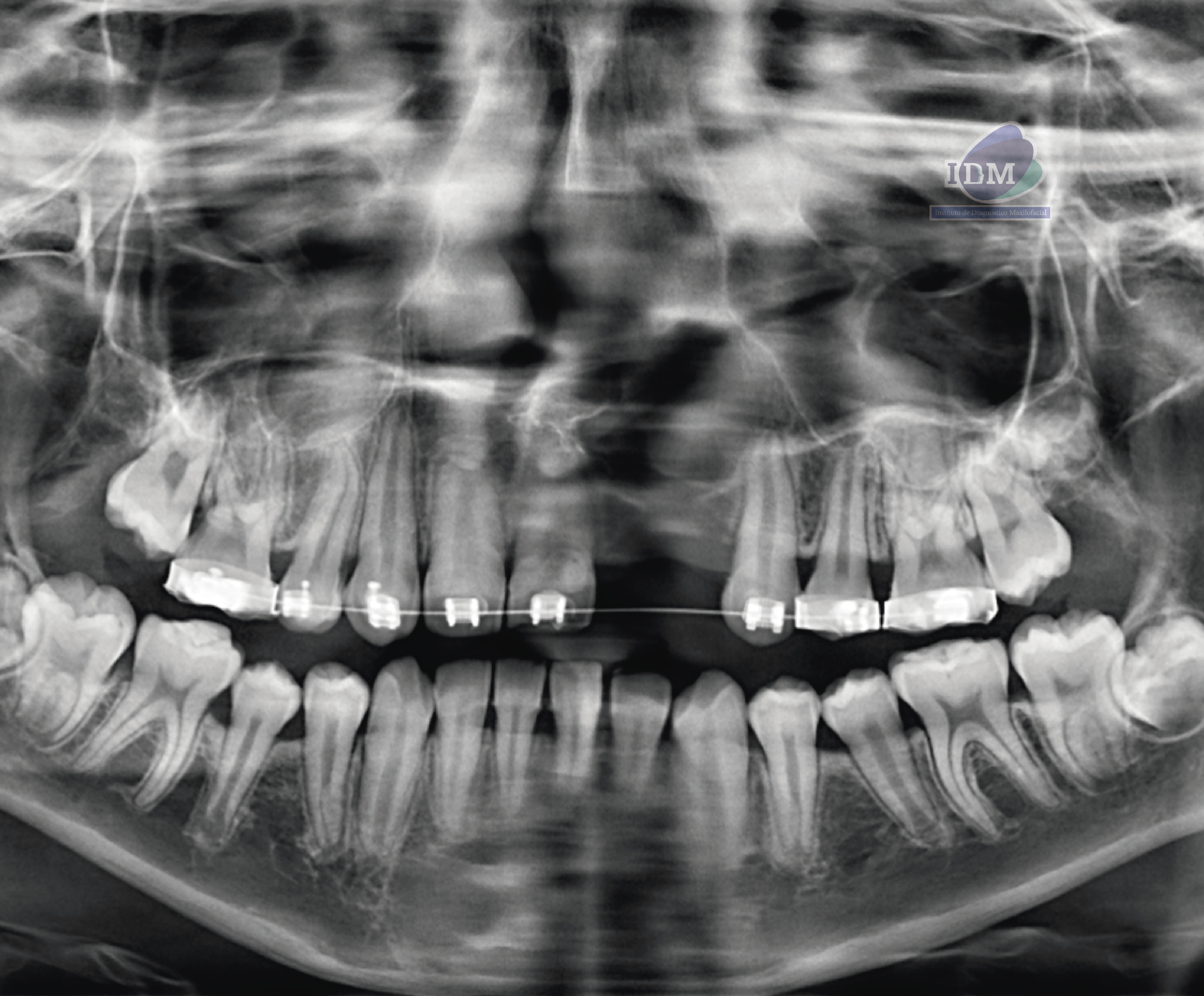 caso 340 - radiografia panoramica IDM_Rad Pan 01_Rad Pan 01