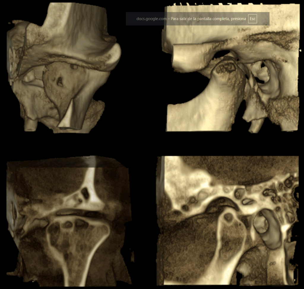 caso 341 - RECONSTRUCCION 3D IDM_rec 3d