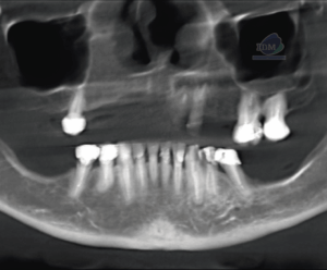 caso 341 - radiografia panoramica 01 IDM_Rad Pan 02_Rad Pan 01