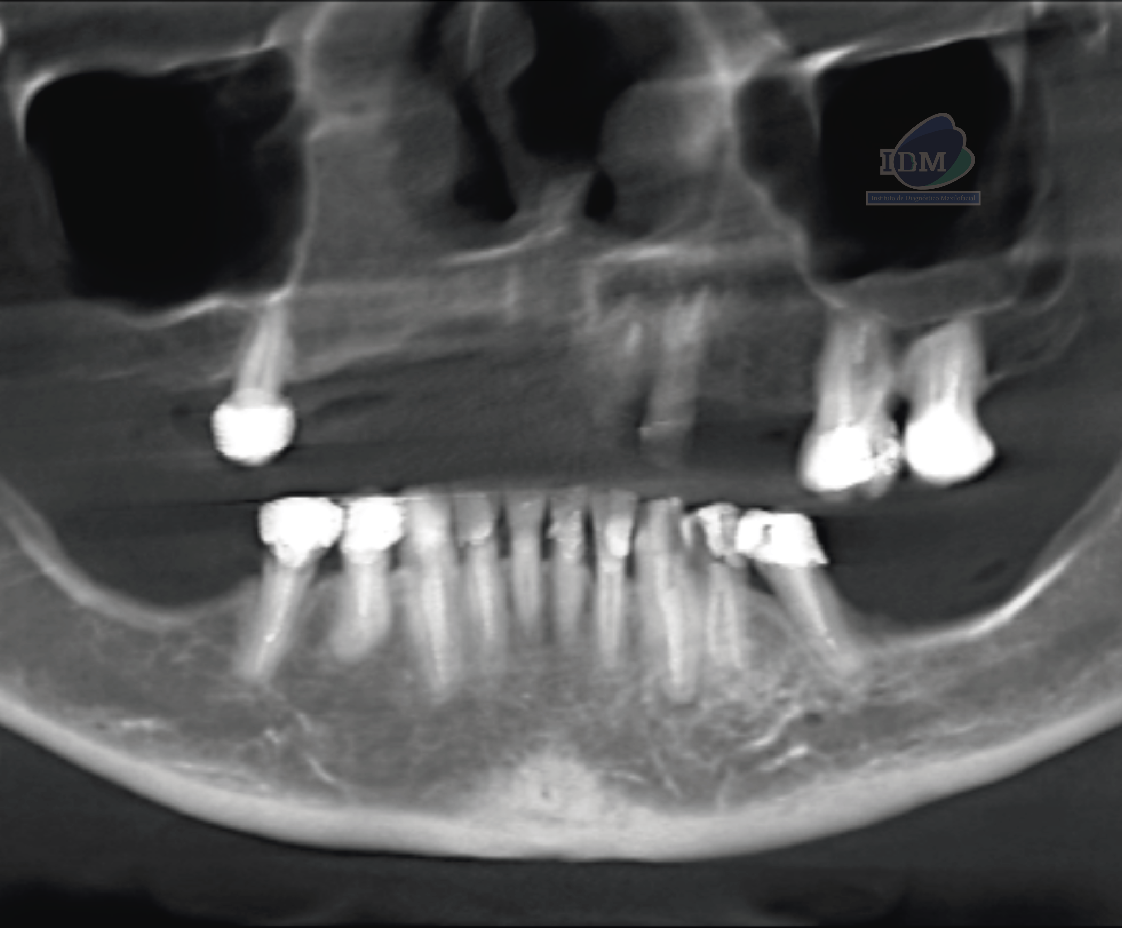 caso 341 - radiografia panoramica 01 IDM_Rad Pan 02_Rad Pan 01