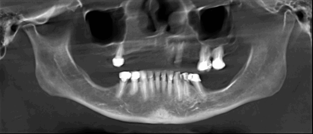 caso 341 - radiografia panoramica 02 IDM_Rad Pan 02