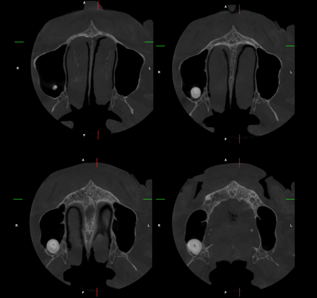 CASO 352 - CORTES AXIALES IDM