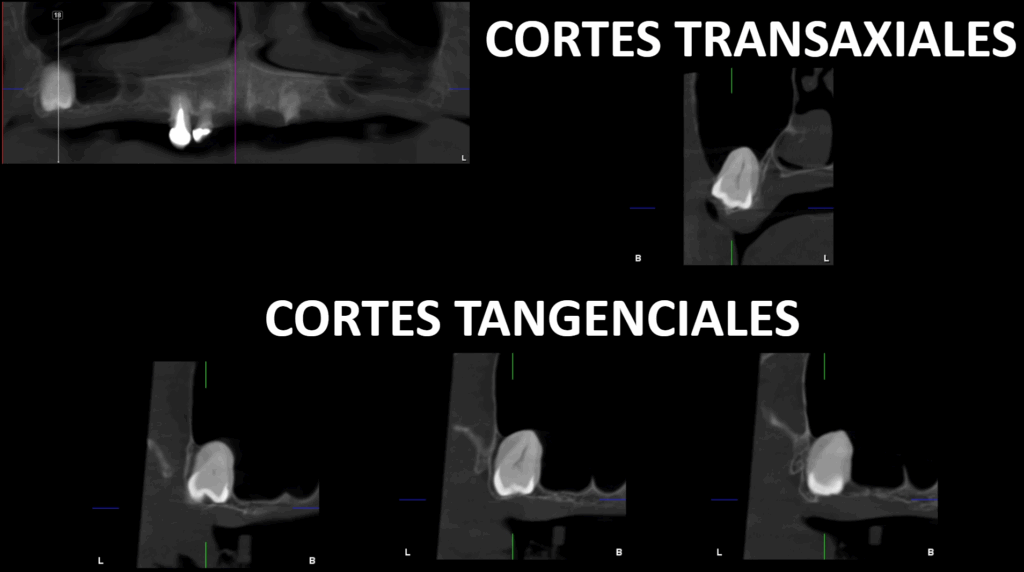 CASO 352 - CORTES TRANSAXIALES Y TANGENCIALES IDM