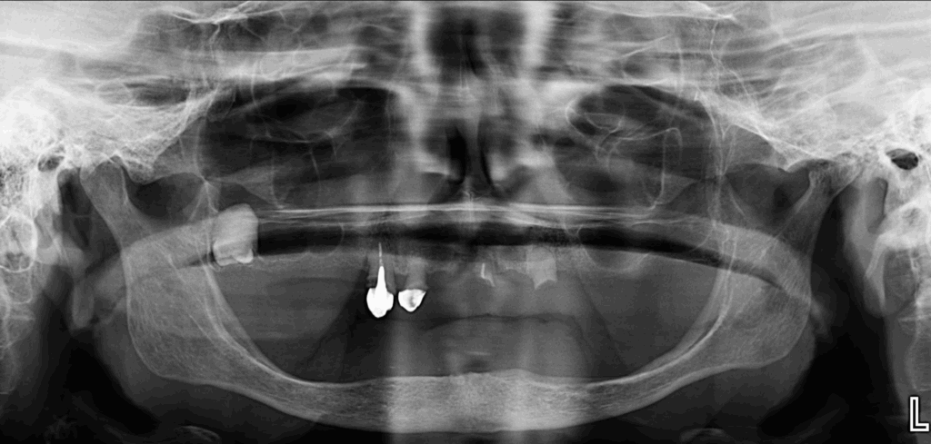 CASO 352 - RADIOGRAFIA PANORAMICA IDM