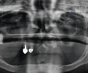 CASO 352 - RADIOGRAFIA PANORAMICA IDM V2_Rad Pan 01