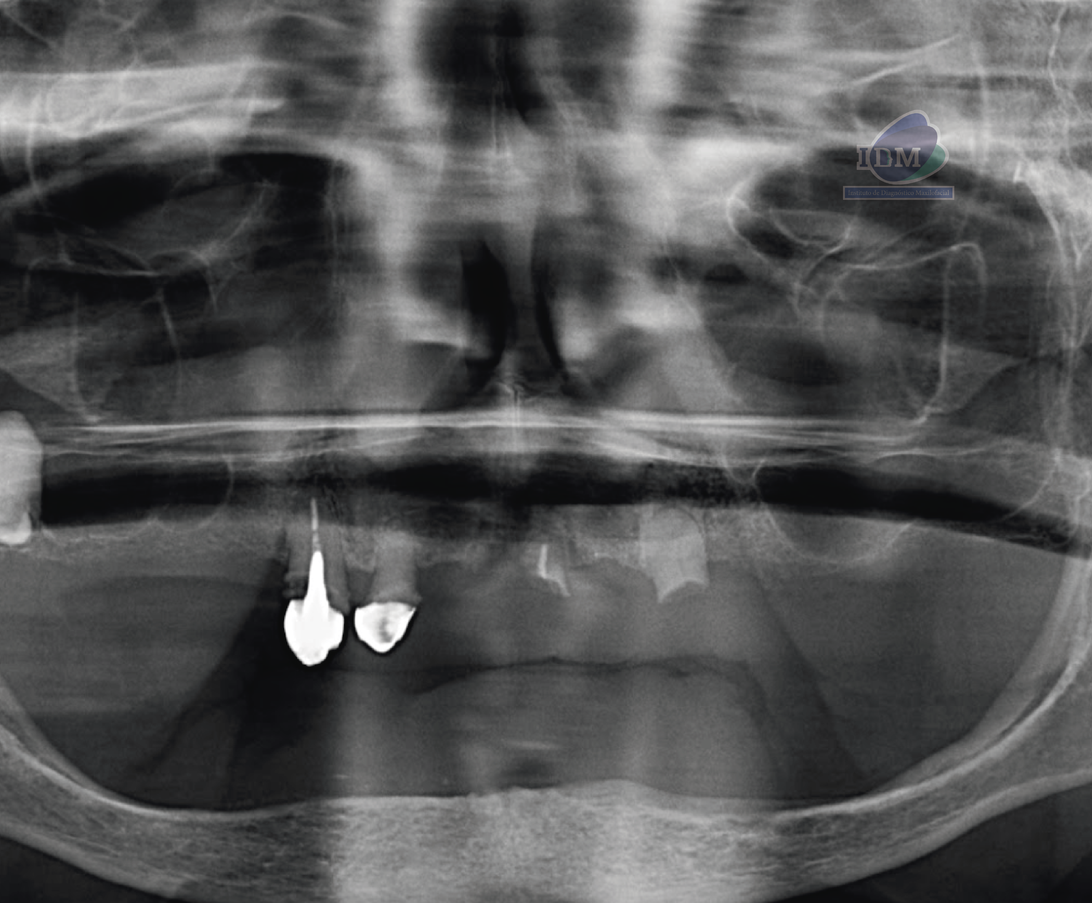 CASO 352 - RADIOGRAFIA PANORAMICA IDM V2_Rad Pan 01