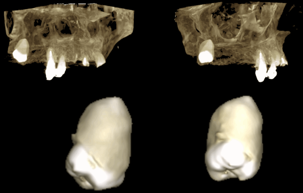 CASO 352 - RECONSTRUCCION 3D IDM