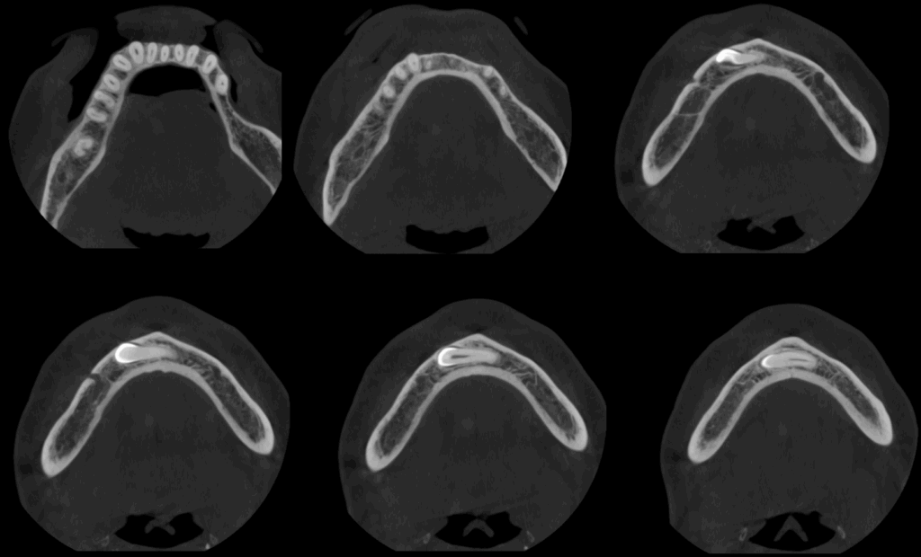 CASO 353 - CORTES AXIALES IDM