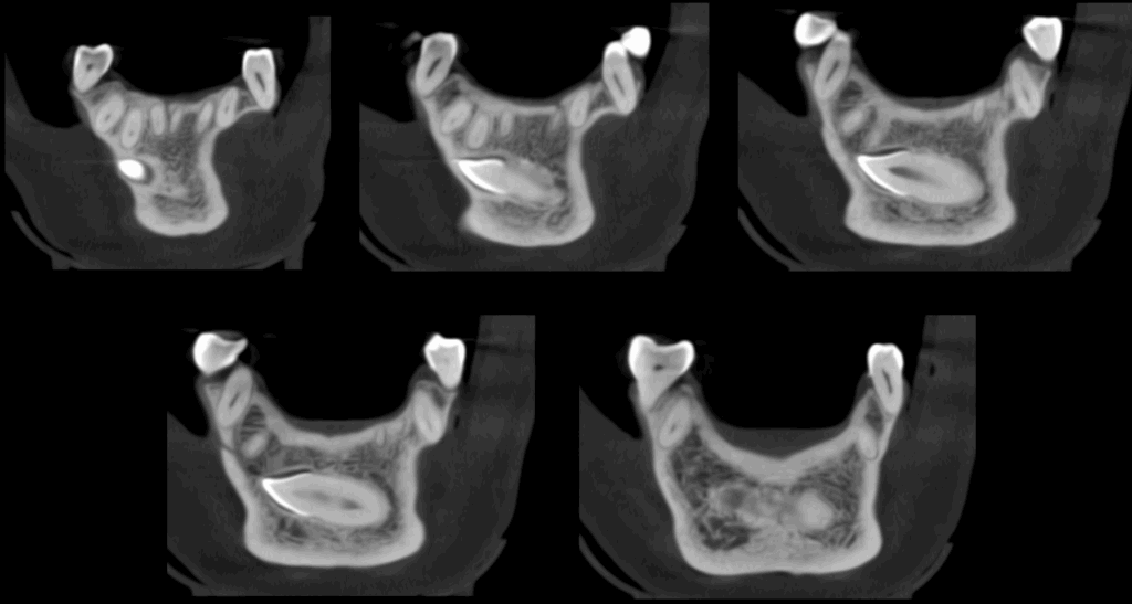 CASO 353 - CORTES TANGENCIALES IDM