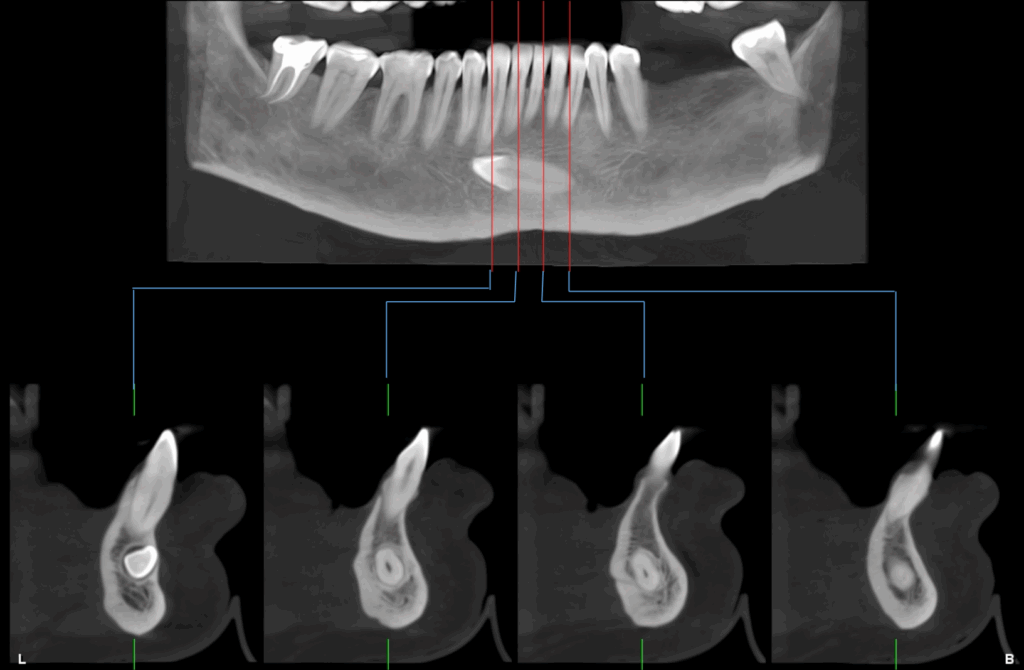 CASO 353 - CORTES TRANSAXIALES IDM