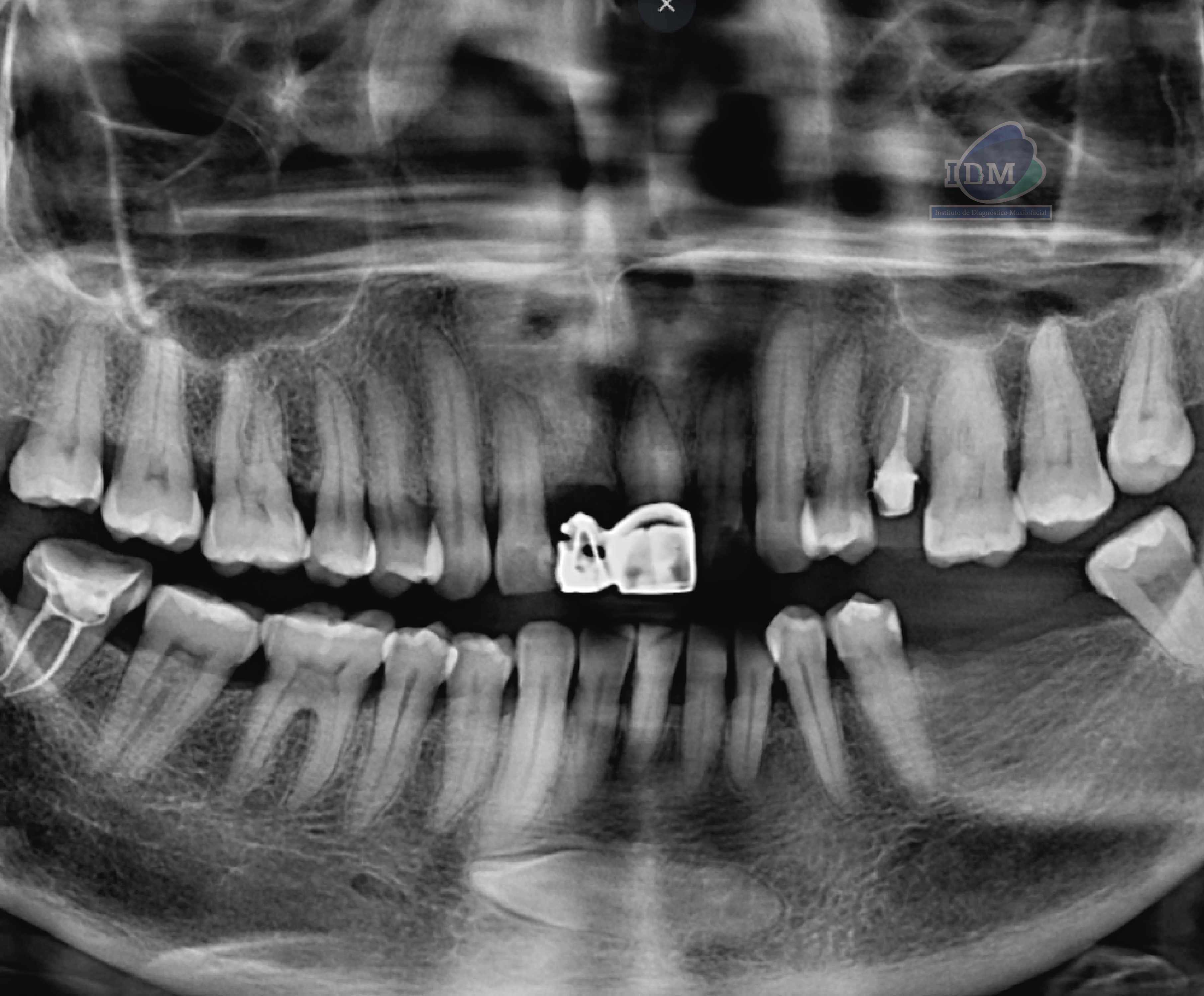 CASO 353 - RADIOGRAFIA PANORAMICA 02 IDM_Rad Pan 01