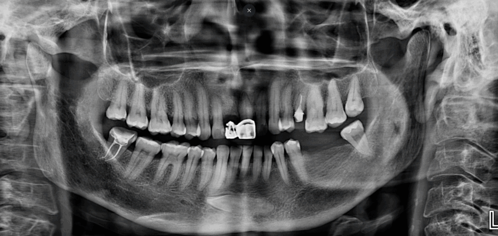 CASO 353 - RADIOGRAFIA PANORAMICA IDM