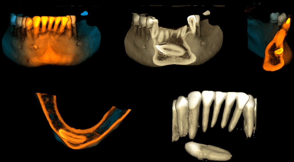 CASO 353 - RECONSTRUCCION 3D IDM