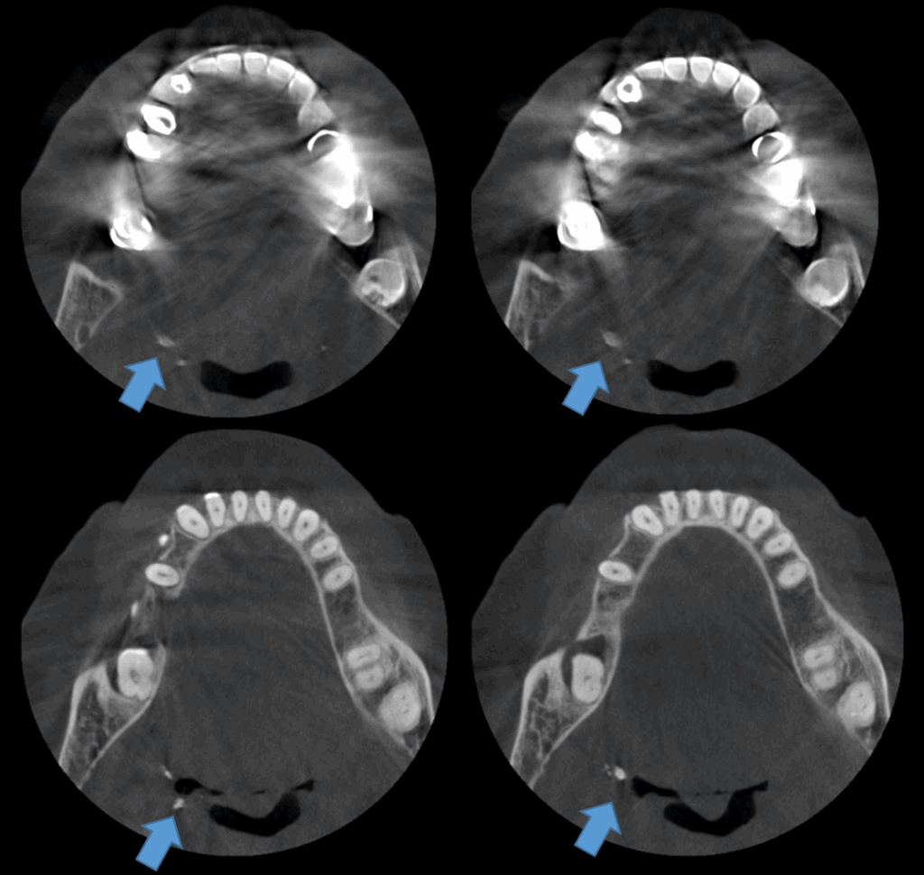 CASO 354 - CORTES AXIALES IDM