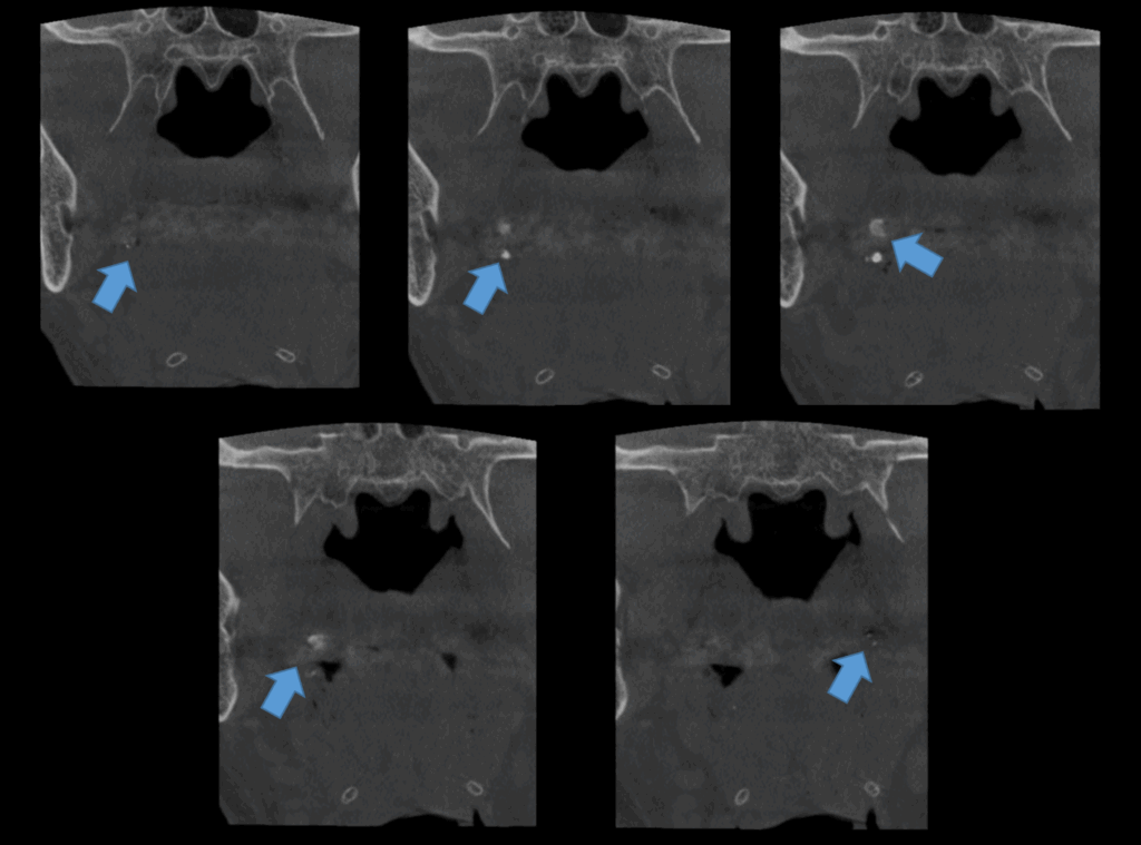 CASO 354 - CORTES CORONALES IDM