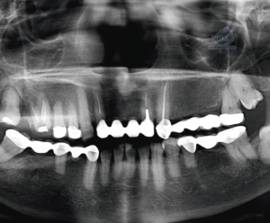 CASO 354 - RADIOGRAFIA PANORAMICA 02 IDM_Rad Pan 01